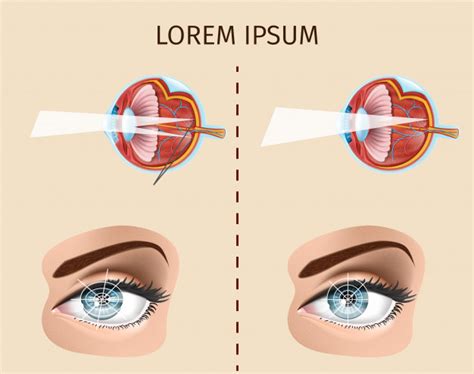 Astigmatismo – tratamiento en CLINICA OFTALMOLOGICA HALCON