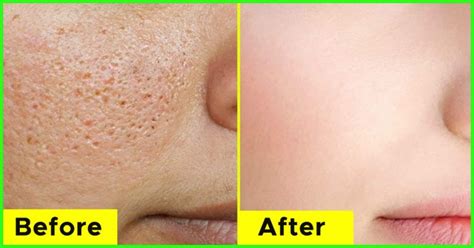 How To Minimize The Appearance Of Large Pores | Grandma's Things