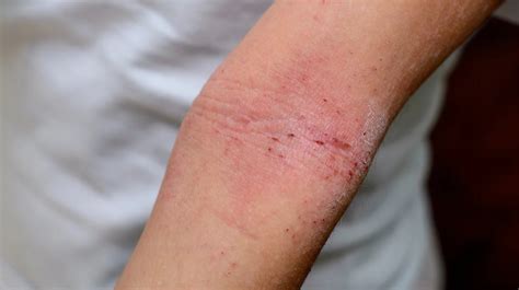 Eczema On Elbows