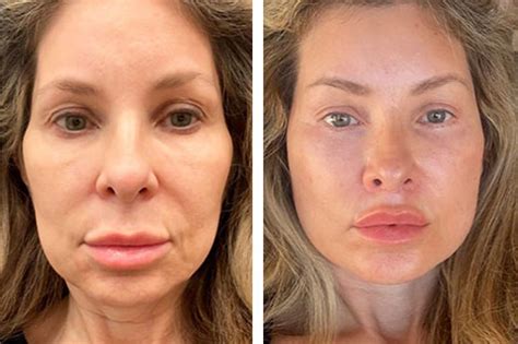 42+ 1 Week Post Op Deep Plane Facelift Scars - ChariseAmara