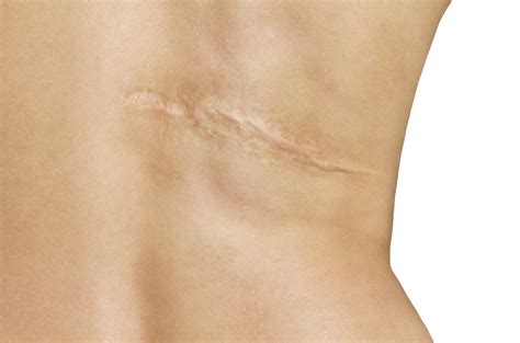 Scar and Recovery Tips: What to Expect After Liposuction – Liposuction vs CoolSculpting