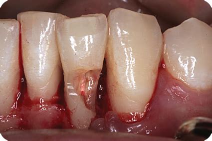 External/Internal Resorption | Pocket Dentistry
