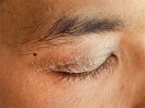 Understanding Dry Eyelids: Causes, Symptoms, and Relief - Phonemantra