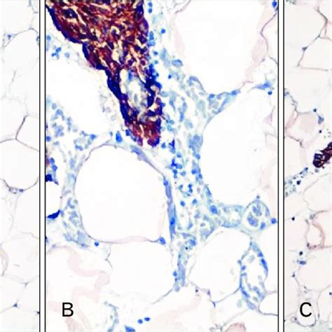 (A) Presence of a large thymic mass in the anterior mediastinum lying... | Download Scientific ...