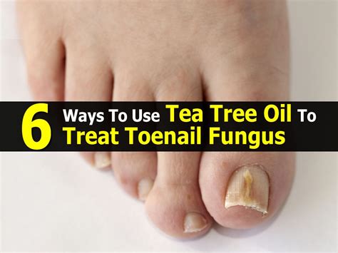 6 Ways To Use Tea Tree Oil To Treat Toenail Fungus