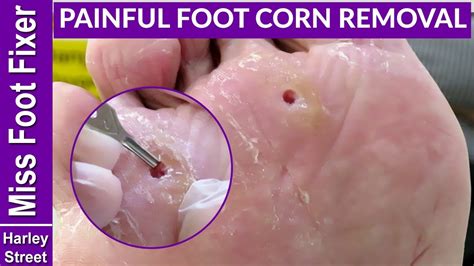 Corn On My Foot Removal Clearance | emergencydentistry.com