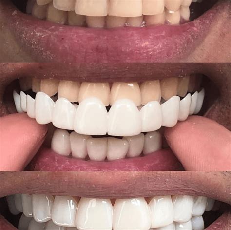 What are clip on veneers? | News | Dentagama | Perfect teeth braces, Perfect smile teeth ...