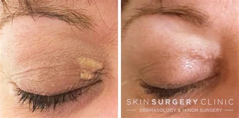 Xanthelasma Removal from £425 in Leeds, Bradford and Harrogate