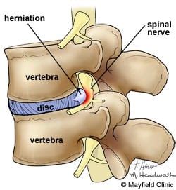 Cervical Radiculopathy Can Cause Neck Pain, Stiffness, And Neuropath