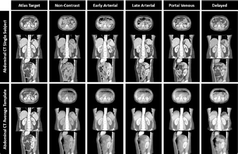 Construction of a Multi-Phase Contrast Computed Tomography Kidney Atlas | Medical-image Analysis ...