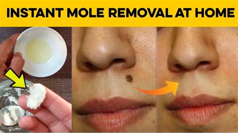 How To Remove Moles On Skin At Home - HOWTORMEOV