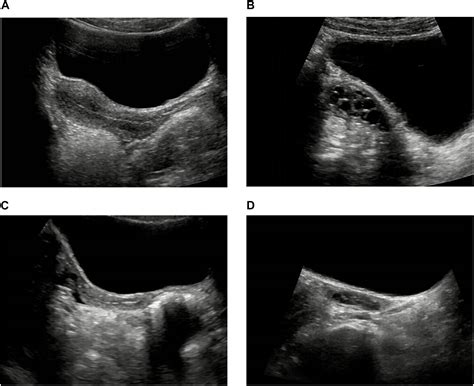 Frontiers | Pelvic Ultrasound in Diagnosing and Evaluating the Efficacy ...