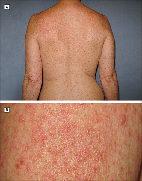 Telaprevir-Related Dermatitis | Dermatology | JAMA Dermatology | JAMA Network