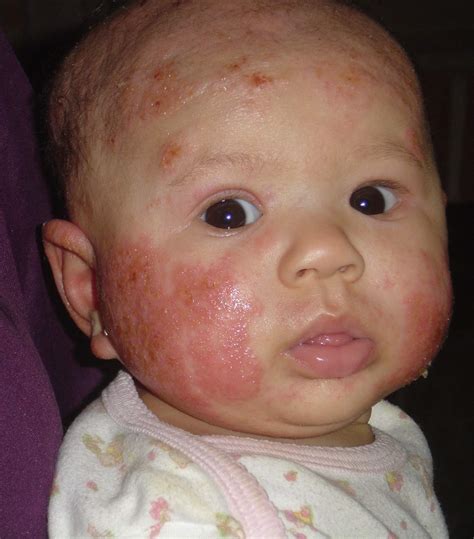 Eczema In Babies Toddlers And Children Snotty Noses - vrogue.co