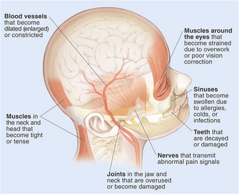 Understanding Headache Pain | Saint Luke's Health System
