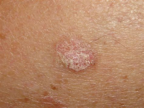 Actinic Keratosis (Solar Keratosis, Sun Spots) - Dermatology Advisor