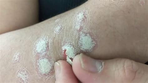 BARNACLES?! [Psoriasis] - YouTube