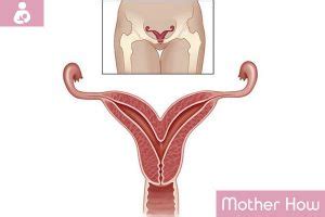 Bicornuate Uterus – Causes, Symptoms &, Treatment - MotherHow