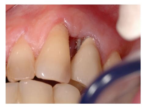 Récession gingivale - Dr Vibert - chirurgien dentiste à Lyon