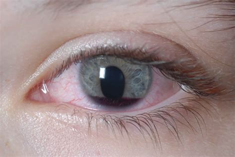 Eye injury causes, traumatic or chemical eye injury symptoms & treatment