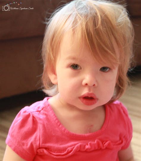 Williams Syndrome: Symptoms, Diagnosis, and Treatments - Clip Art Library