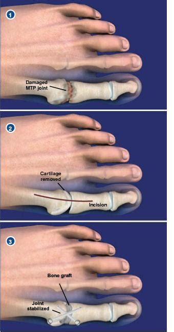 Arthritis Why It Hurts: Understanding Arthritis Pain - Mayra Flores