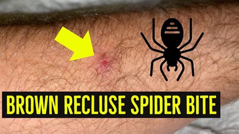 Brown Recluse Spider Bite | Brown recluse spider bite, Recluse spider bite, Recluse spider