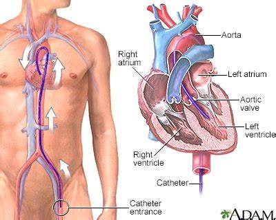 Cardiovascular syndrome ALCAPA | Vinmec