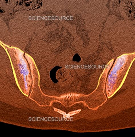 CT Scan of Pelvis Shows Sacroiliitis | Stock Image - Science Source Images