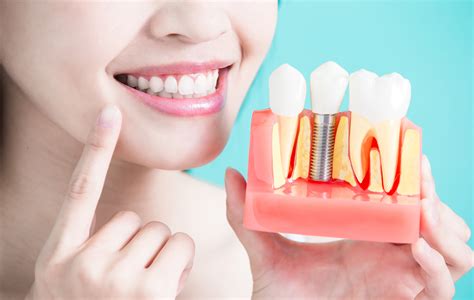 Dental Implants Abbotsford | Restore Smile with Dental Implants