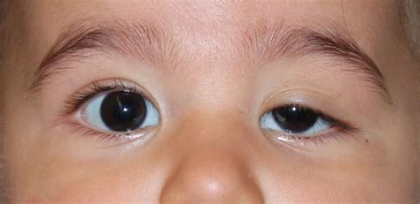 Congenital eyelid ptosis - Miranza