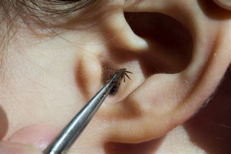 Le dolía el oído y descubrieron que tenía una araña en su interior