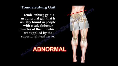 Trendelenburg Gait - Everything You Need To Know - Dr. Nabil Ebraheim ...