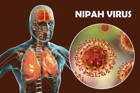 Nipah Virus, Newly Emerging Zoonotic Infection with Respiratory Disorders and Encephalitis Stock ...