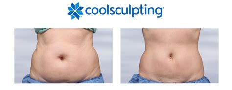 Coolsculpting Landing Page 2 - The Centre for Dermatology