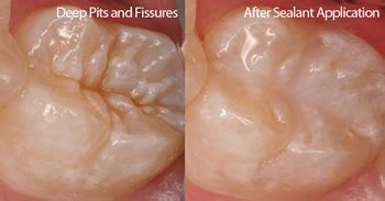 Fissure Seals | Seven Hills Dentist | Capstone Dental