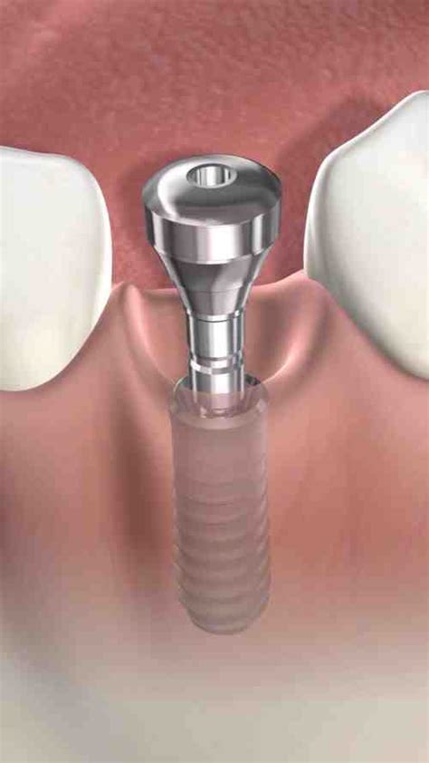 What does a titanium dental implant screw look like - Dental News Network