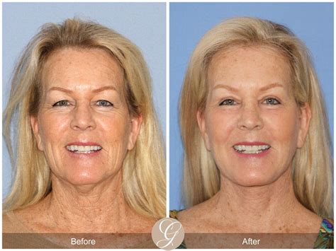 Neck Lift Before & After Photos From Dr. Kevin Sadati