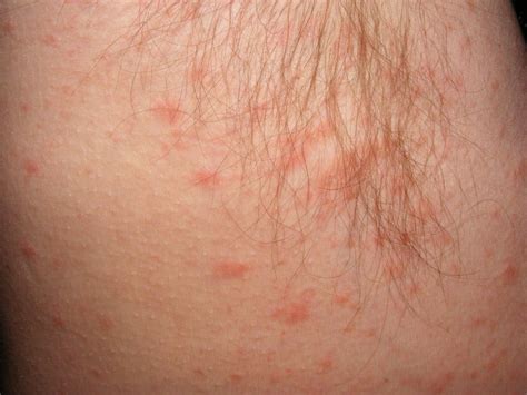 Why Do I Have A Rash Near My Armpit at Dale King blog