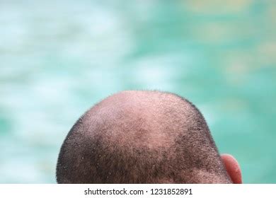 Bald Mans Head Hair Transplant Stock Photo 1231852891 | Shutterstock