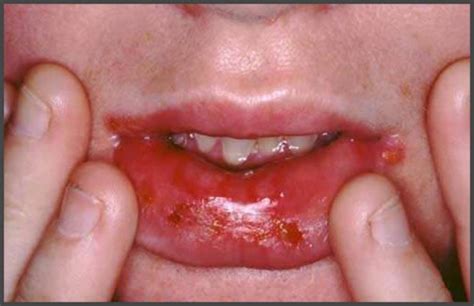 shingles in mouth and throat pictures | Shingles Expert