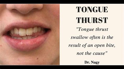 Pin on Tongue thrust treatment