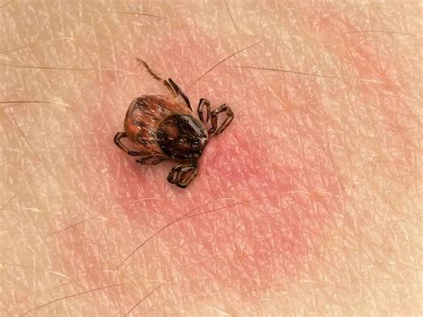 How to Identify Tick Bites | Tick Bite Pictures | IGeneX Tick Talk