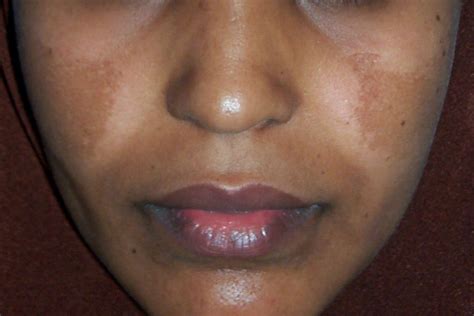 Melasma on Dark Skin: Appearance, Diagnosis, Management