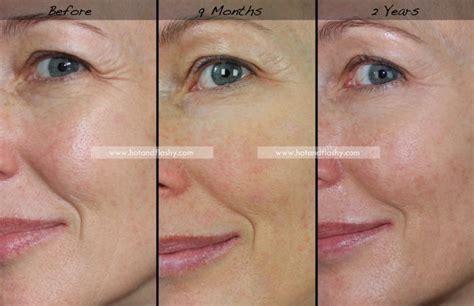 Retin-A for Wrinkles ~ 2 Year Update – hotandflashy.com Tretinoin ...