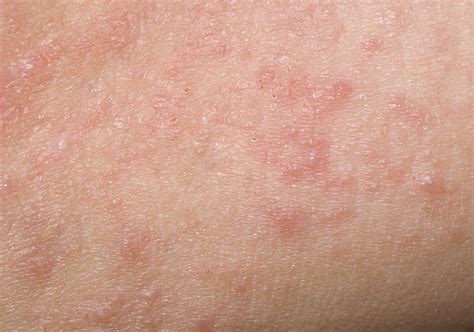 Contact Dermatitis: Overview and More