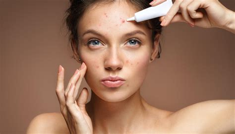 A Health and Beauty Shoot Needs Models With Acne + 2 More Gigs