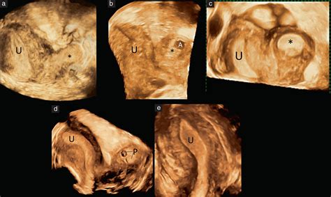 Reproductive outcome in 326 women with unicornuate uterus - Tellum - 2023 - Ultrasound in ...