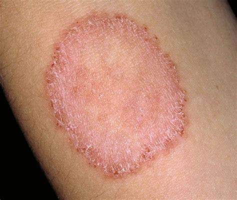 Ringworm: Signs, Symptoms, and Complications