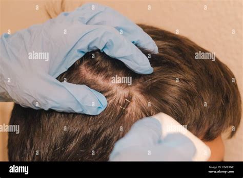 doctor with gloves showing head wound with two stitches placed with ...